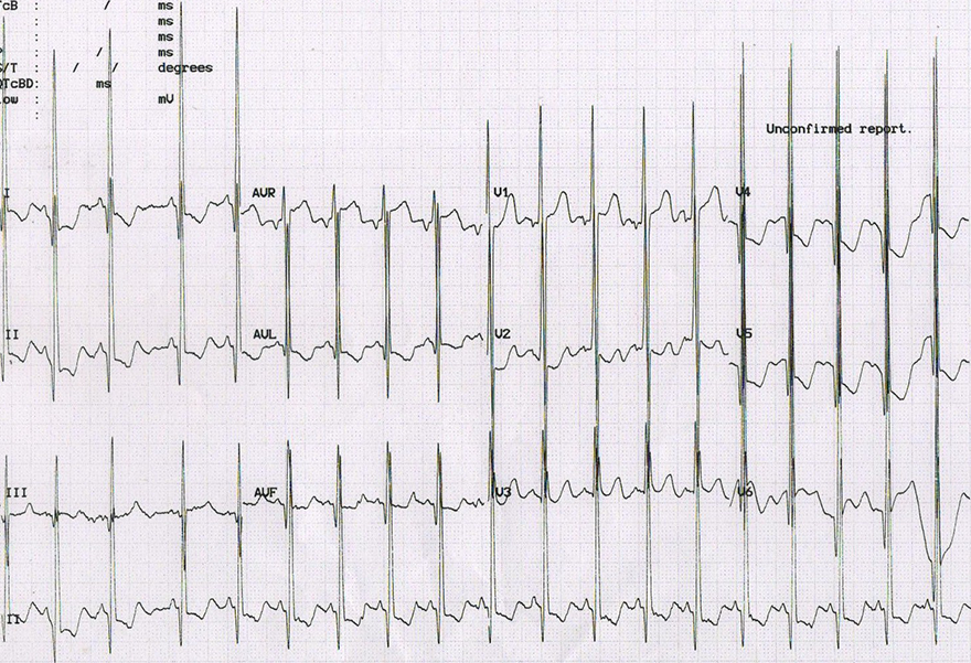 ECG biventricular hypertrophy, Katz-Wachtel phenomenon, P pulmonale, Enormous voltages - QRS amplitude