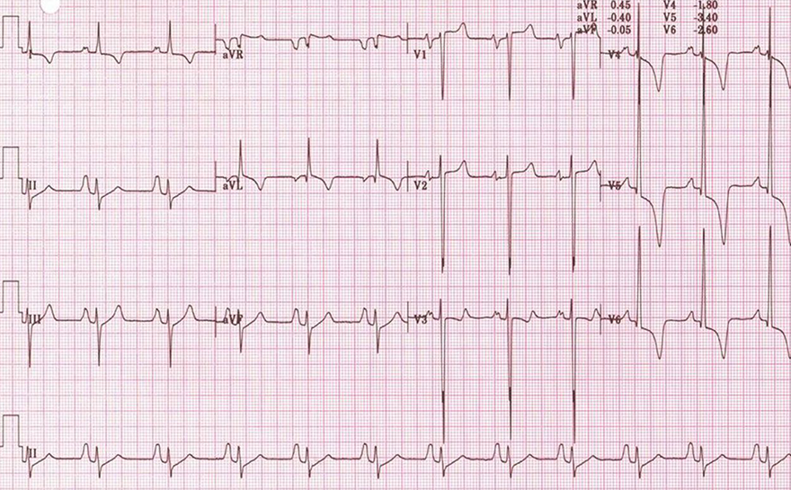 ECG athlete hypertrophic cardiomyopathy, QRS voltage criteria for LVH, deep TWI and ST segment depression, left atrial and right atrial enlargement, left axis deviation