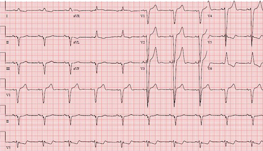 Abnormal ECG athlete left bundle branch block (LBBB)