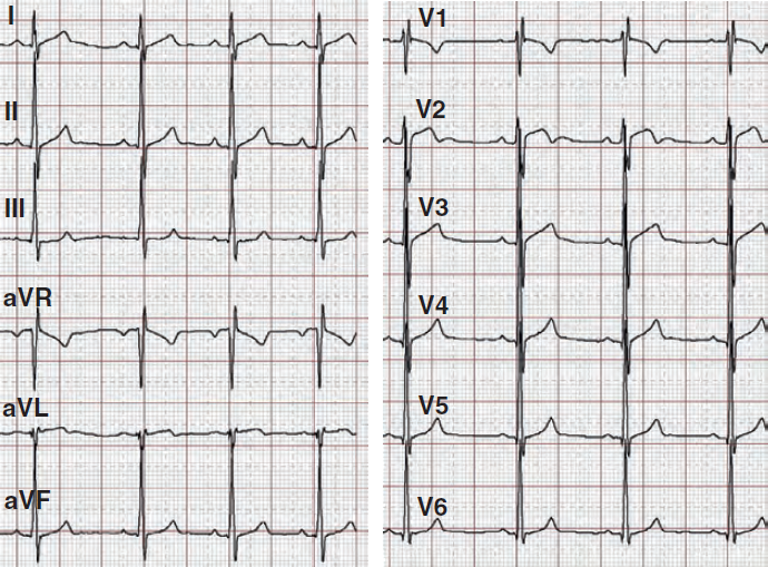 ECG healthy athletes, incomplete right bundle branch block (RBBB)