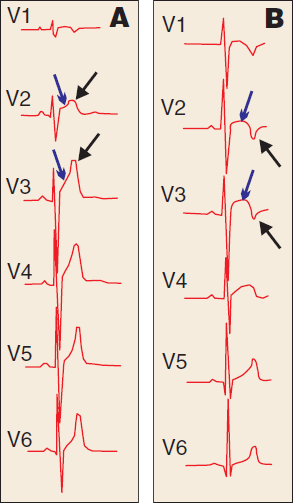 ECG in two healthy athletes, early repolarization, concave and convex ST segment elevation, negative T wave, positive T wave