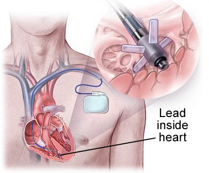 Pacemaker electrode fixation in heart - tines