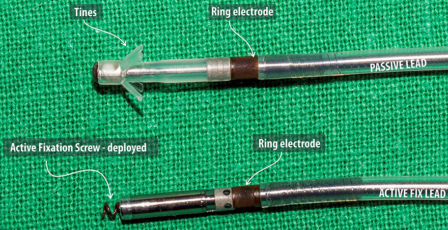 Passive lead (ring electrode, tines), Active fix lead (active fixation screw - deployed, ring electrode)
