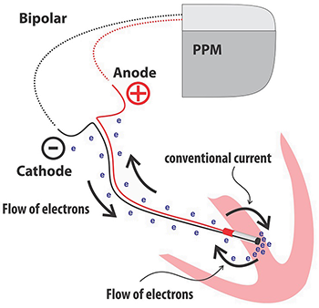 Bipolar PPM (permanent pacemaker), cathode, anode, flow of electrons, conventional current