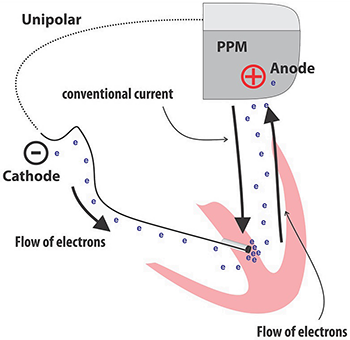 Unipolar PPM (permanent pacemaker), cathode, anode, flow of electrons, conventional current