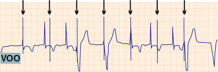 ECG VOO pacing (single chamber modes), spikes