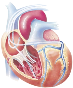 CRT (Cardiac Resynchronization Therapy), Lead in right atrium, Lead in right ventricle, Lead within coronary sinus vein