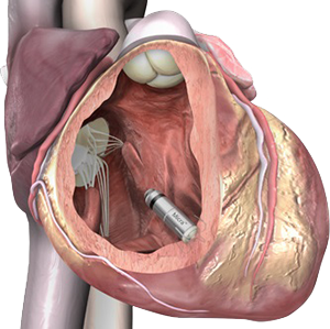Single chamber Tiny pacemaker with no leads