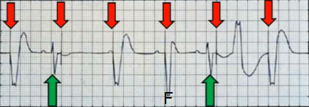 ECG pacemaker VOO mode