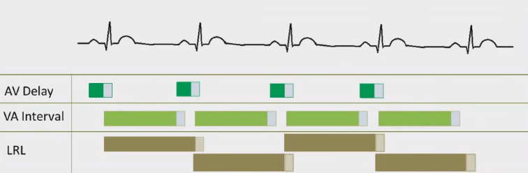 ECG pacemaker, Lower Rate Limit, AV delay, Ventricle to Atrium