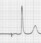 ECG spike, atrial pacing