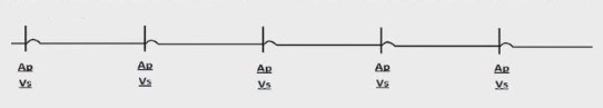 ECG pacemaker cross talk, atrial pacing, ventricular sensing