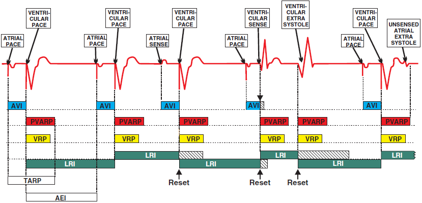 ECG pacemaker timing cycles, AVI, PVARP, VRP, LRI, TARP, AEI interval