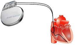 Upper rate behavior, Dual chamber pacemaker pacing, sensing lead