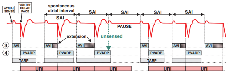 ECG DDD (AsVp) pacemaker wenckebach, AVI, PVARP, TARP, URI, SAI (spontaneous atrial interval)