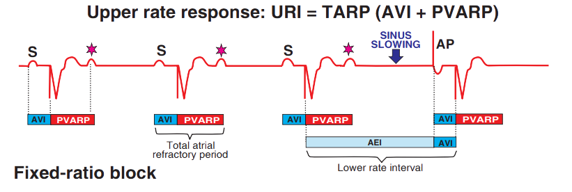 Pacemaker uppper rete response: URI = AVI + PVARP, Fixed-ratio block 2:1
