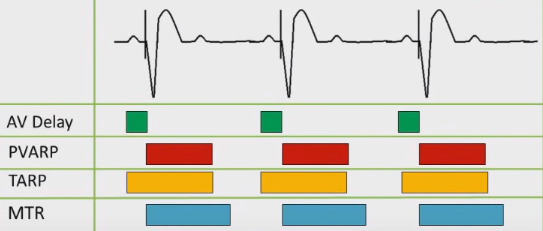 ECG pacemaker, Upper rate behavior 2:1 response, AV interval, PVARP, TARP, MTR, URL
