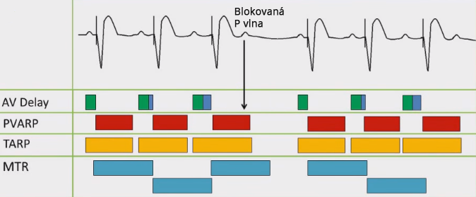 ECG pacemekar upper rate response wenckebach (4:3), AV block 2:1 - Wenckebach, AV delay, PVARP, TARP, MTR