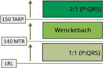 Pacemaker upper rate response, LRL, 1:1 conduction, MTR, Wenckebach, TARP, 2:1 block