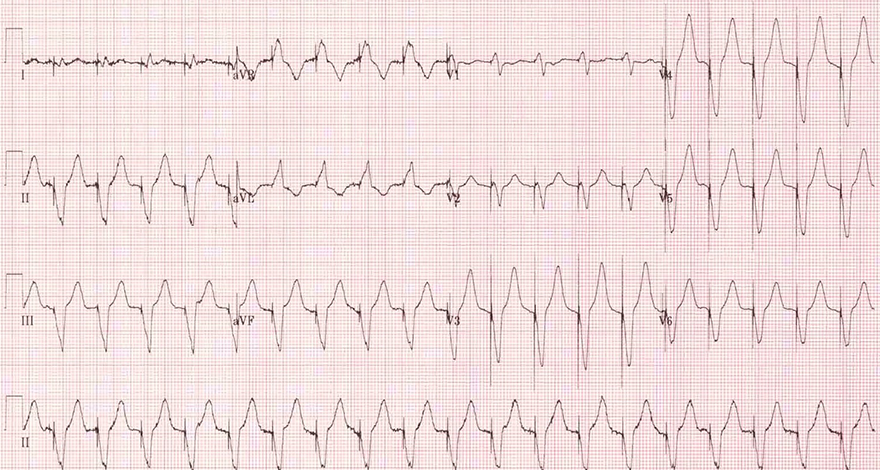 ECG spikes, Pacemaker mediated tachycardia (PMT), Endless loop tachycardia (ELT), Pacemaker Circus movement tachycardia (PcmT)