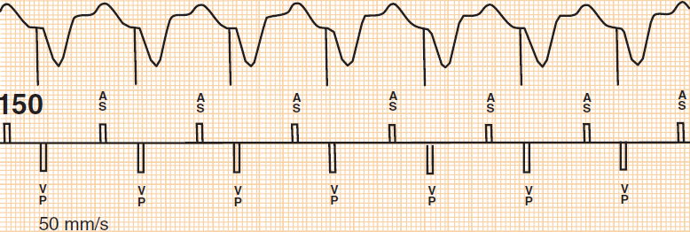 ECG dual chamber pacemaker DDD (AsVp), Pacemaker mediated tachycardia (PMT), Endless loop tachycardia (ELT), Pacemaker Circus movement tachycardia (PcmT)