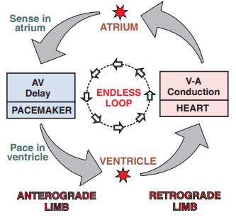 Endless loop tachycardia (ELT), Sense in atrium, AV delay, pacemaker, pace in ventricle, V-A conduction, endless loop, anterograde and retrograde limb