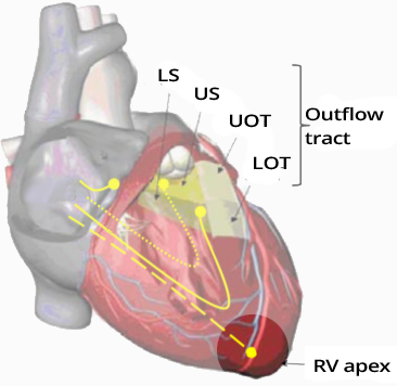 Heart right ventricular apical pacing