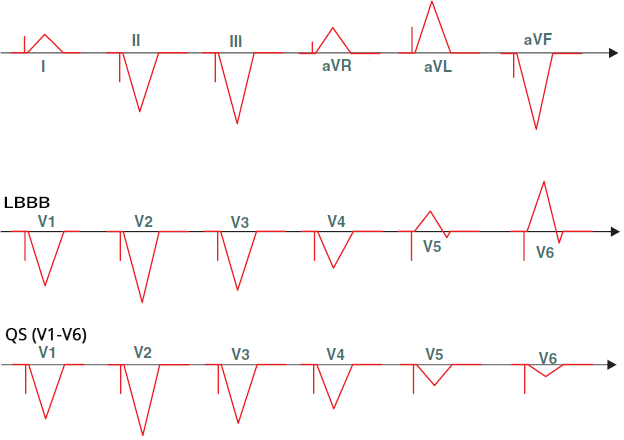 ECG pacemaker, right ventricular (RV) apical pacing