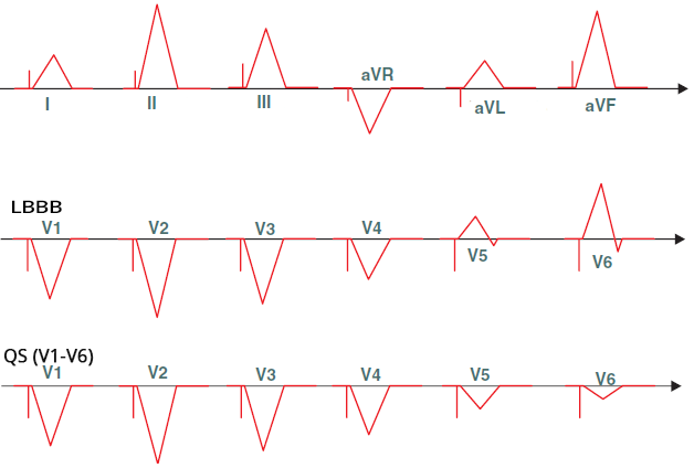 ECG pacemaker, Right ventricular outflow tract pacing