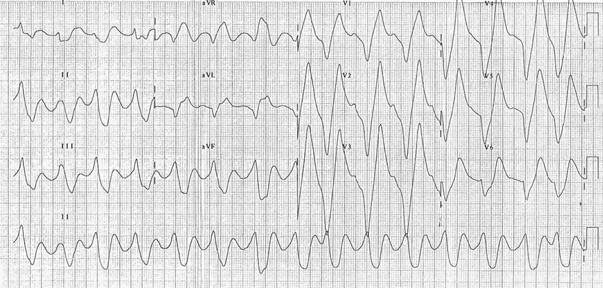 ECG pattern hyperkalemia, 9mmmol