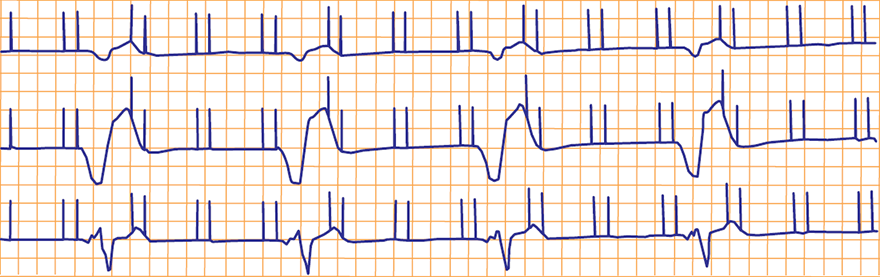 ECG pacemaker mode DDD (ApVp), hyperkalemia, pacemaker exit block 1st degree
