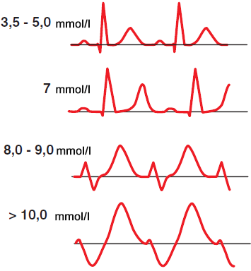 ECG hyperkalemia level pattern