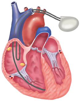 Pacemaker and hyperkalemia