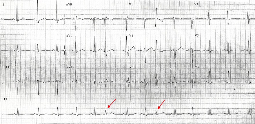 ECG aberrant conduction RBBB morphology, absolute refractory period in right bundle branch