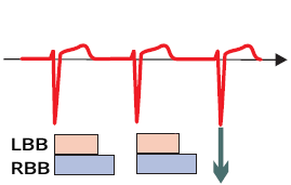 ECG normal supraventricular impulse conduction via ventricular conduction system
