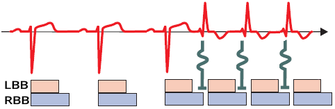 ECG Tachycardia-dependent-aberration, Tachycardia-dependent (phase 3) BBB, supraventricular tachycardia (SVT) with RBBB morphology