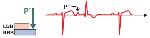 ECG aberrant conduction RBBB, phase 3 aberrancy with RBBB morphology