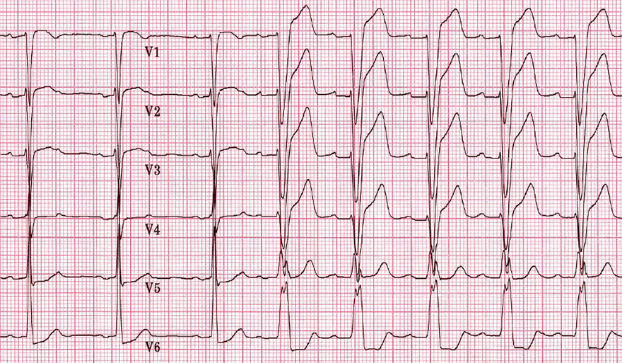 ECG Tachycardia-dependent (phase 3) LBBB pattern