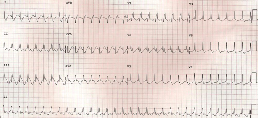 ECG Tachycardia-dependent aberration (Typical phase 3 aberrancy), RBBB pattern