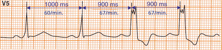 ECG Tachycardia-dependent aberration, LBBB pattern