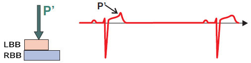 Phase 3 Aberrancy. Premature atrial complex block in refractory period