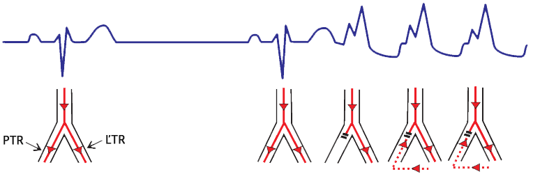 ECG Retrograde invasion of bundle branch, tachycardia-dependent block or aberrancy during supraventricular tachycardia