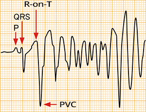 Phenomenon R on T, malignant ventricular arrhythmia