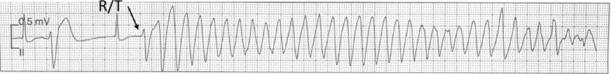 ECG phenomenon R on T, and Torsades de Pointes