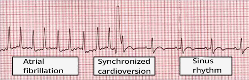 ECG atrial fibrillation, synchronized cardioversion with QRS
