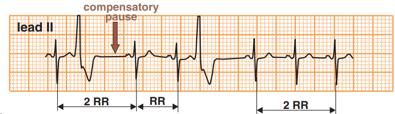 ECG premature ventricular complex, full compensatry pause