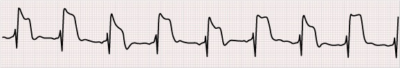 ECG acute STEMI infarction, electrical ST segment alternans