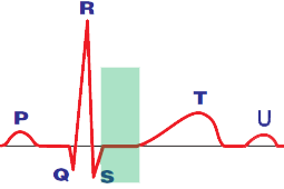 ST segment alternans, Electrical alternans
