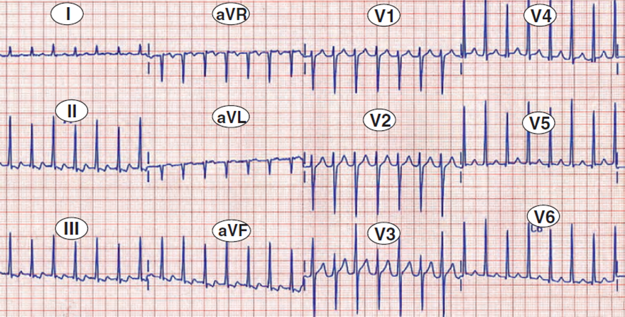 ECG electrical QRS alternans, orthodromic avrt
