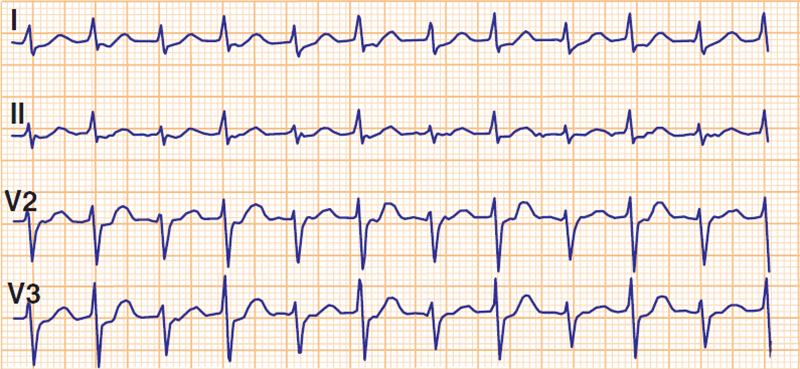ECG Conduction / Refractoriness alternans, QRS complex alternans, Repolarization T wave alternans